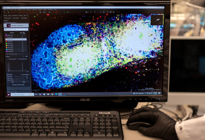 Przełomowa szczepionka na raka trzustki może przedłużyć pacjentom życie nawet o 6 lat